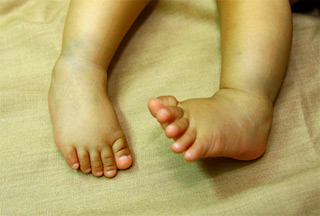 Example of congenital clubfoot (source)