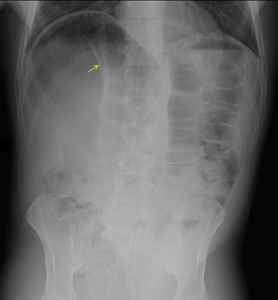 The falciform ligament can be clearly visualized on this KUB due to free air around the structure (source) 