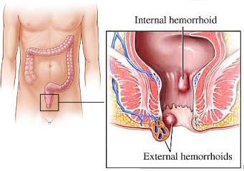 Anatomy of internal and external hemorrhoids (source) 