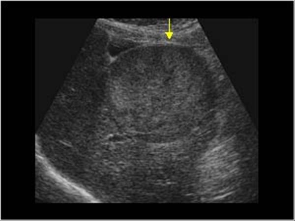 Visual appearance of HCC on ultrasound (source) 