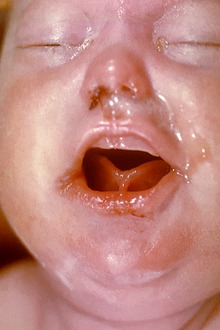 Baby with signs of congenital syphilis, mainly snuffles and rhagades (source)