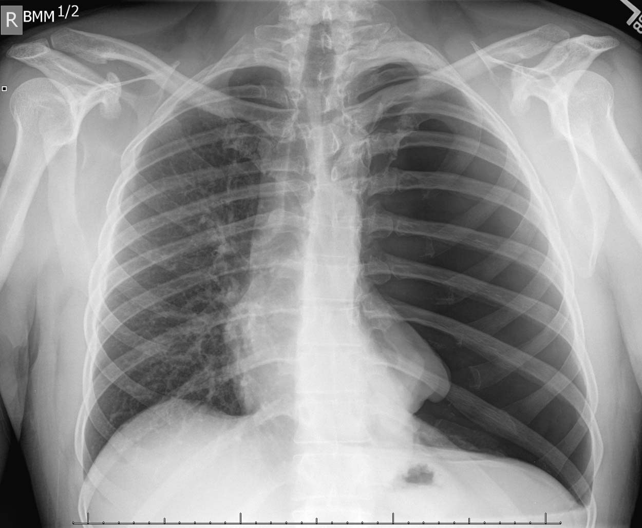 Tension pneumothorax on the left side. Note the shifted airway as well as cardiac structures towards the patient's right (source) 