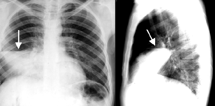 Right middel lobe pneumonia seen on PA and lateral X-rays (source)