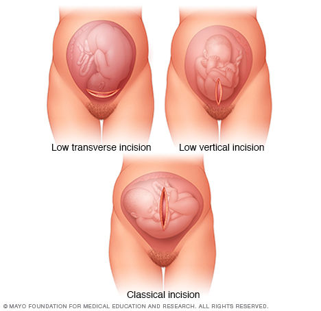 Different uterine incisions used during cesarean delivery (source)