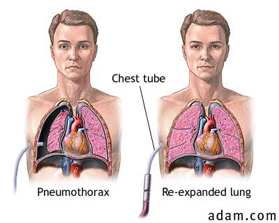 The purpose of the chest tube is to allow for the escape of the trapped air in the pleural space (source) 