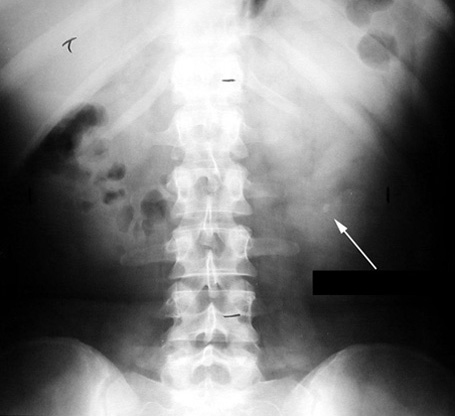 Kidney stone visualization on abdominal X-ray (source) 