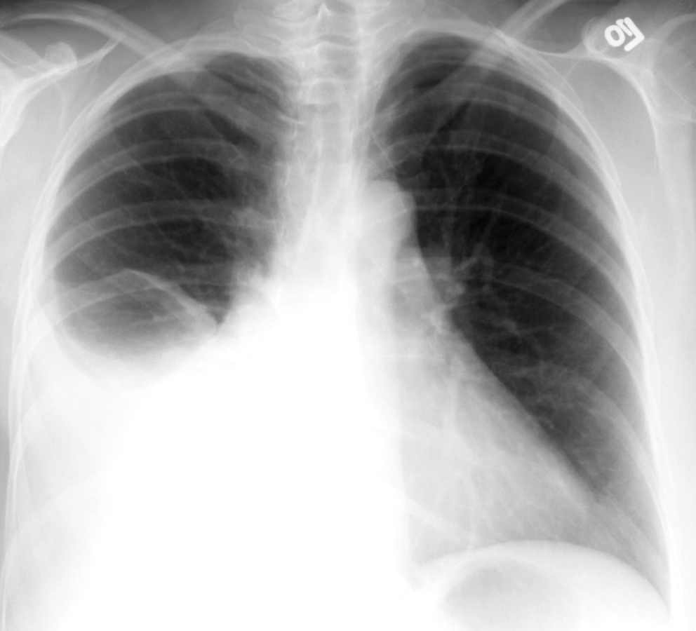 Chest X-ray showing pleural effusion on the right (source)