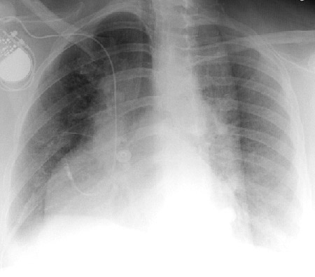 In this rotated image (position of clavicles gives this away) it is difficult to interpret the anatomy of the patient (source)