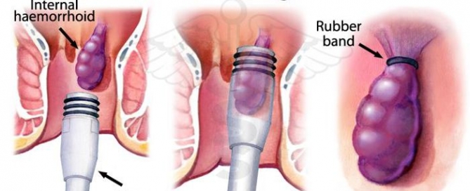 Band ligation of internal hemorrhoids (source) 