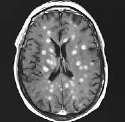 Soap bubble lesions in the brain consistent with Cryptococcus neoformans infection (source). 