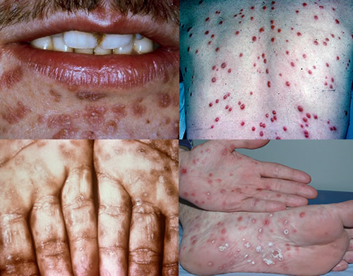 Secondary syphilis rash seen on various parts of patient's bodies (source) 