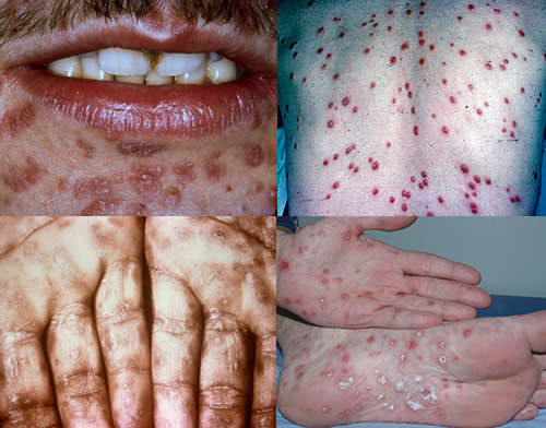 Secondary syphilis rash seen on various parts of patient's bodies (source)