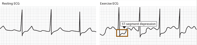A resting ECG is without ST changes in this patient. Upon exercising, the stress test reveals ST depressions which are suggestive of ischemia (source) 