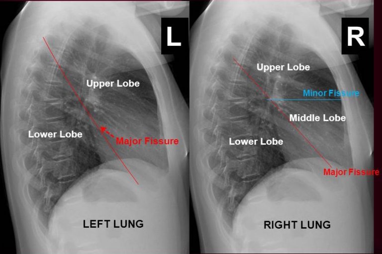 Interpreting A Chest XRay Stepwards