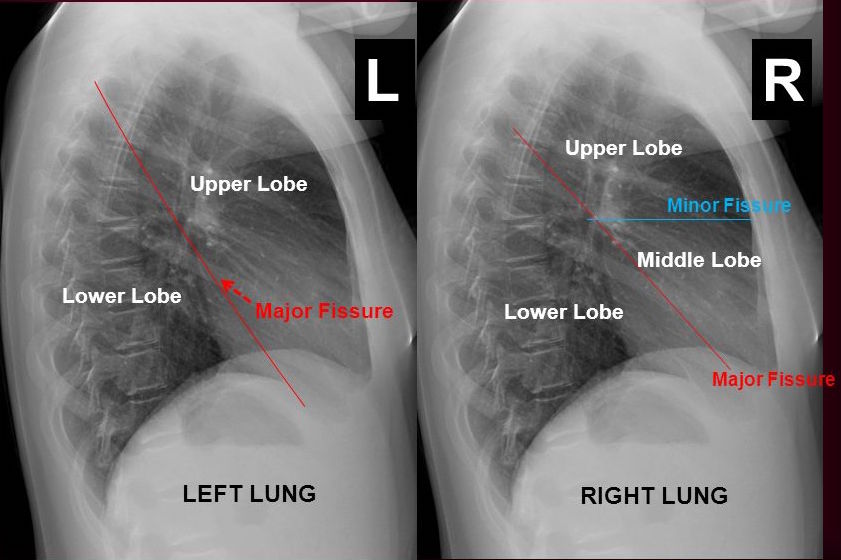 Anatomical location of the right and left lung fissures (source)