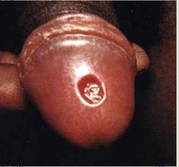 Primary syphilis chancre on the tip of the penis (source)