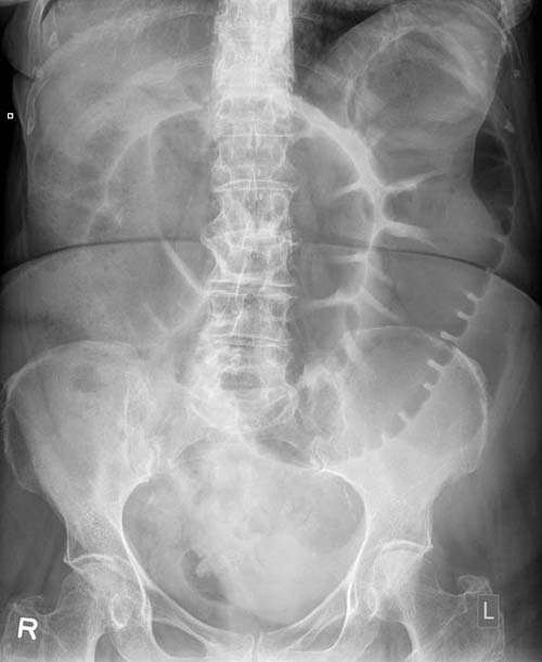 Dilated transverse colon that could be a result of large bowel obstruction (source) 