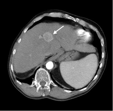 An enhancing lesion suggestive of HCC can be seen on the contrast CT scan above (source)
