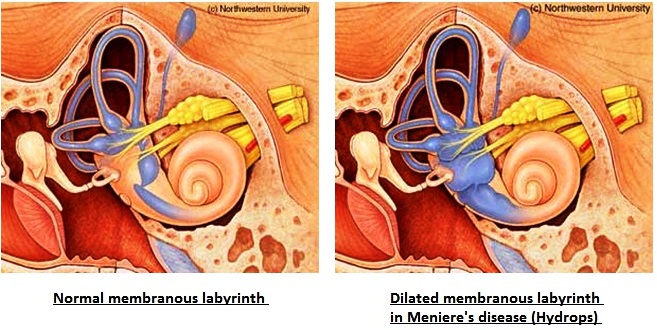 Meneire's disease is thought to be caused by increased fluid buildup in the structures of the ear (source)