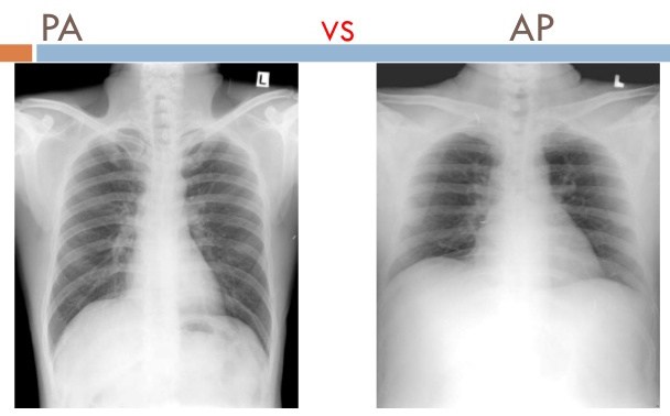 Comparison of PA vs. AP views of chest X-rays. Note the larger appearing heart on the AP view. This is because the distance is increased between the film and the heart,allowing for the X-rays to spread for a greater distance before developing the film (source)