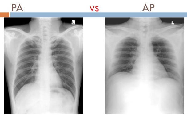 Comparison of PA vs. AP views of chest X-rays (source) 