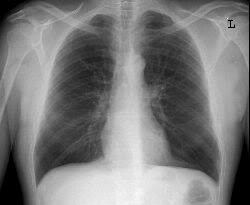 Flattened hemidiaphrams seen on the chest X-ray of a patient (source) 