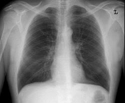 Flattened hemidiaphrams seen on the chest X-ray of a patient (source)