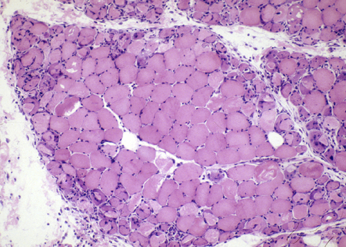 Muscle biopsy of a patient with dermatomyositis shows perifasicular inflammation and atrophy (source)