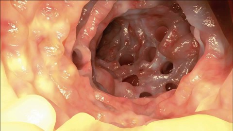 While contraindicated during active inflammation, diverticula can bee seen with a colonoscopy (source)