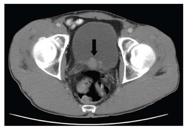 Visual appearance of bladder cancer seen on a CT scan (source)