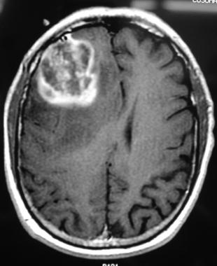 Visual appearance of a glioblastoma on a T1 weighted MRI image (source)