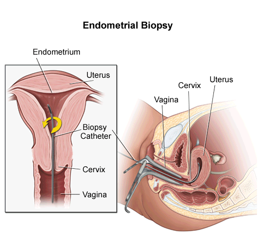 Endometrial biopsy technique (source)