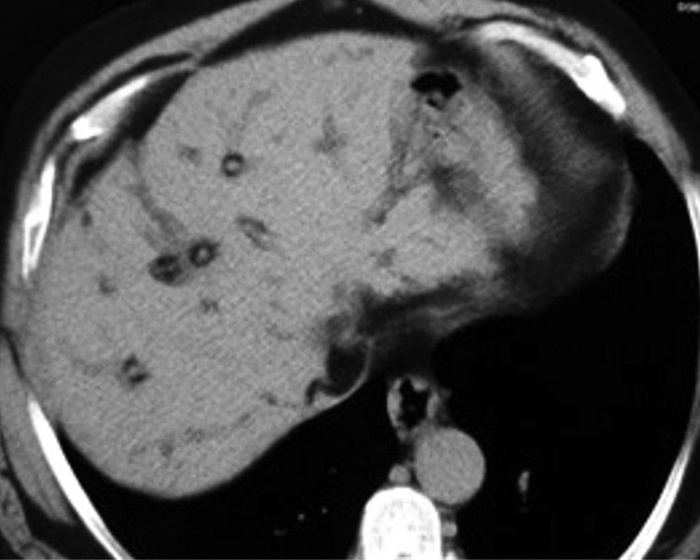 Patient with liver cirrhosis secondary to schistomiasis (source) 