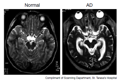 MRI comparison between a normal control and patient with AD. The affected individual shows atrophy of brain tissues (which results in increased CSF to replace lost tissues, source)