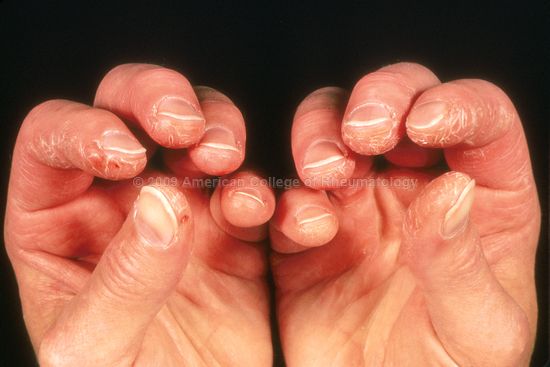Mechanic's hands seen in a patient with dermatomyositis (source) 