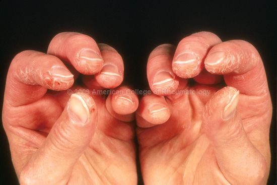 Mechanic's hands seen in a patient with dermatomyositis (source)