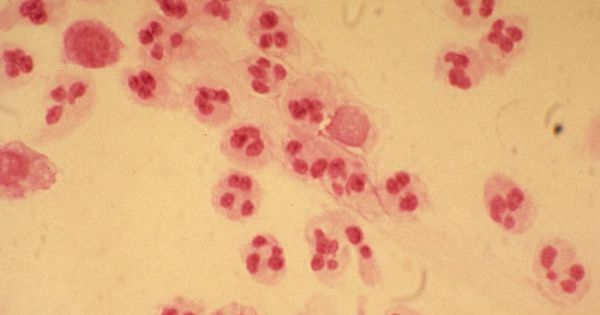 Gram stain of urethral discharge showing only white blood cells. This is suggestive of a nongonococccal urethritis (source)