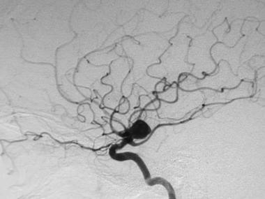 Angiography showing a large aneurysm in the cerebral circulatory system (source)