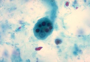 Visual appearance of Entamoeba histolytica trophozoite. Note that this organism contains 1 nuclei and multiple red blood cells in it's cytoplasm (source)