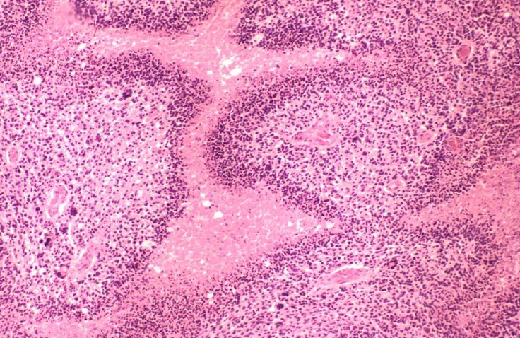 Visual appearance of psuedopalisading tumor cells on a histological sample of glioblastoma (source) 