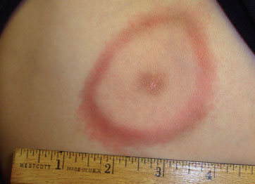 Example of target lesion from Lyme disease (source)