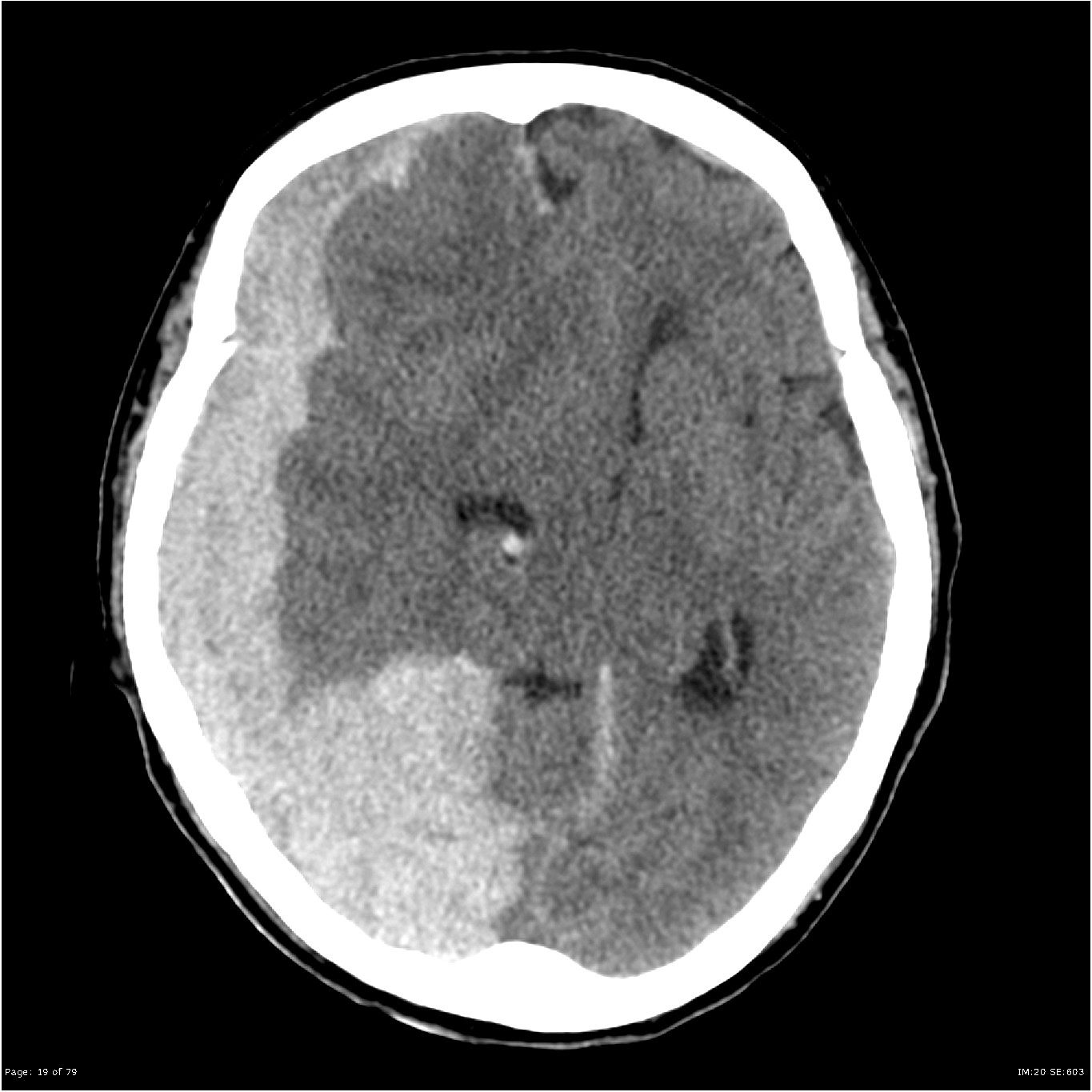 Large subdural hemorrhage in a patient who was on Warfarin (source)