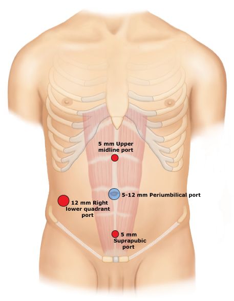 Port placement for a laparoscopic left hemicolectomy (source)