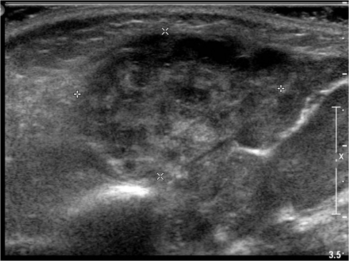 The parotid gland can be visualized and measured with ultrasound (as shown above) to help confirm parotitis (source) 