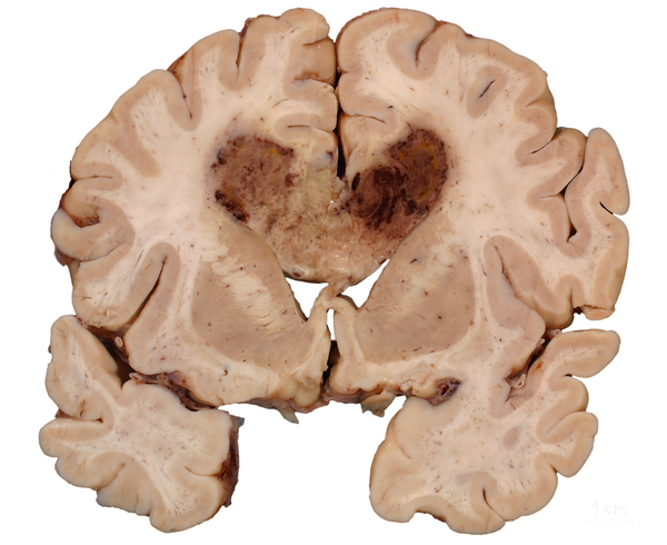 Gross histology depicting a "butterfly lesion" that crosses the corpus callosum (source) 