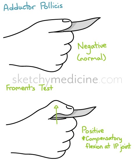 Schematic showing positive Froment's sign (source) 