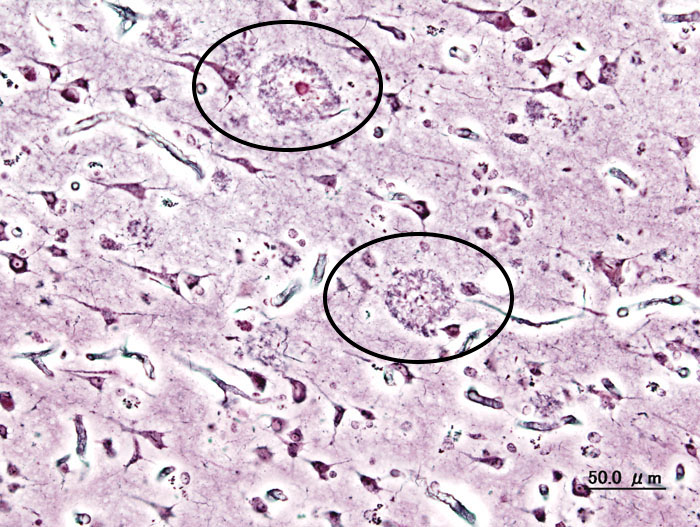 Histology of a patient's brain who has AD shows senile plaques in the cortical tissues (source)