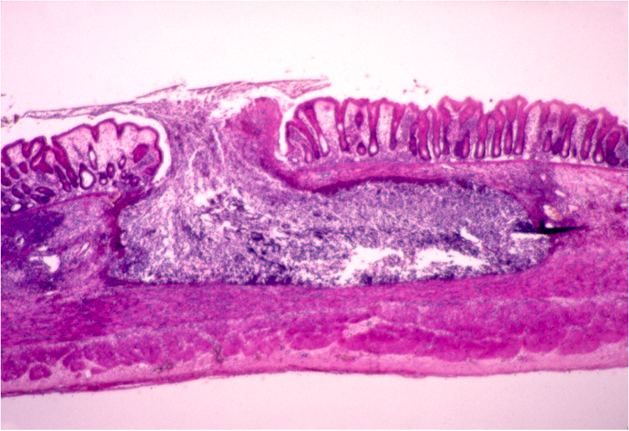 Flask shaped ulcer in a histological sample of a patient with amebiasis (source)
