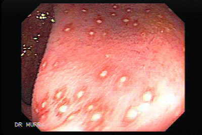 Endoscopy of amebic colitis (source)