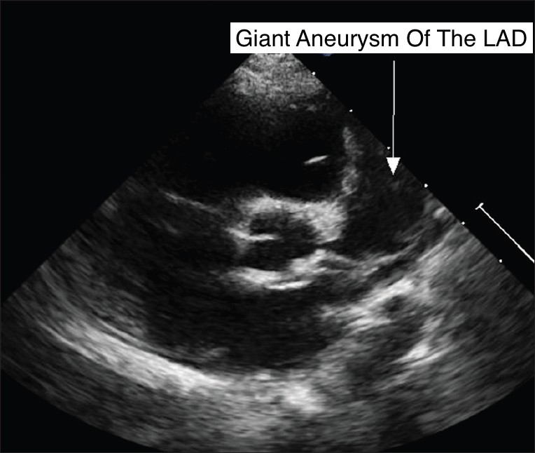 Echo in an infant with Kawasaki disease that shows a coronary artery aneurysm (source) 